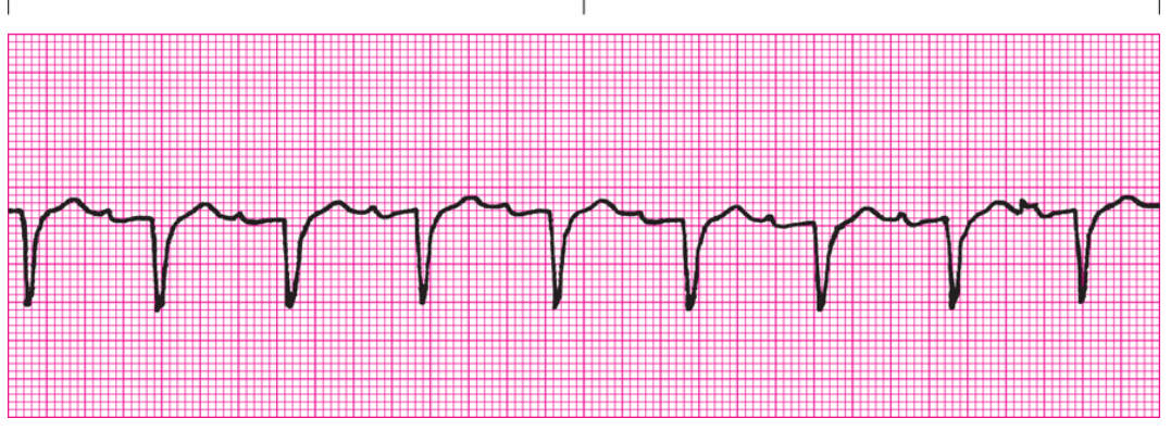 <p>5-step method: P waves?</p>
