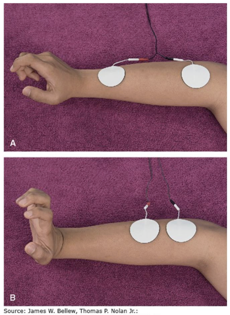 <ul><li><p>base off what the treatment is trying to accomplish </p></li><li><p>ex: motor nerves = motor points (muscle belly or proximal 1/3) </p></li><li><p>interelectrode distance - distance between electrodes </p><ul><li><p>wider placements =  greater depth of penetration/more motor unit or sensory fiber activation </p></li></ul></li></ul><p></p>