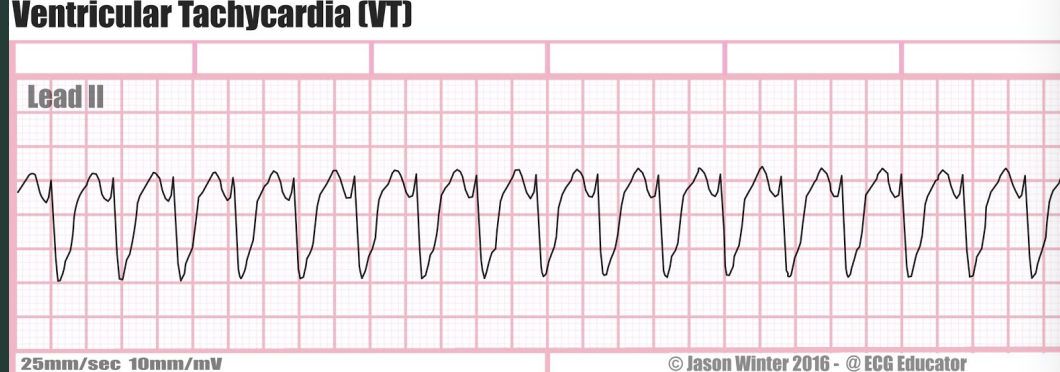 <p>What defines ventricular tachy (VT)? </p>