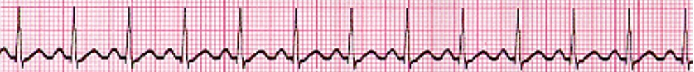 <p>What dysrhythmia is this EKG showing?</p>