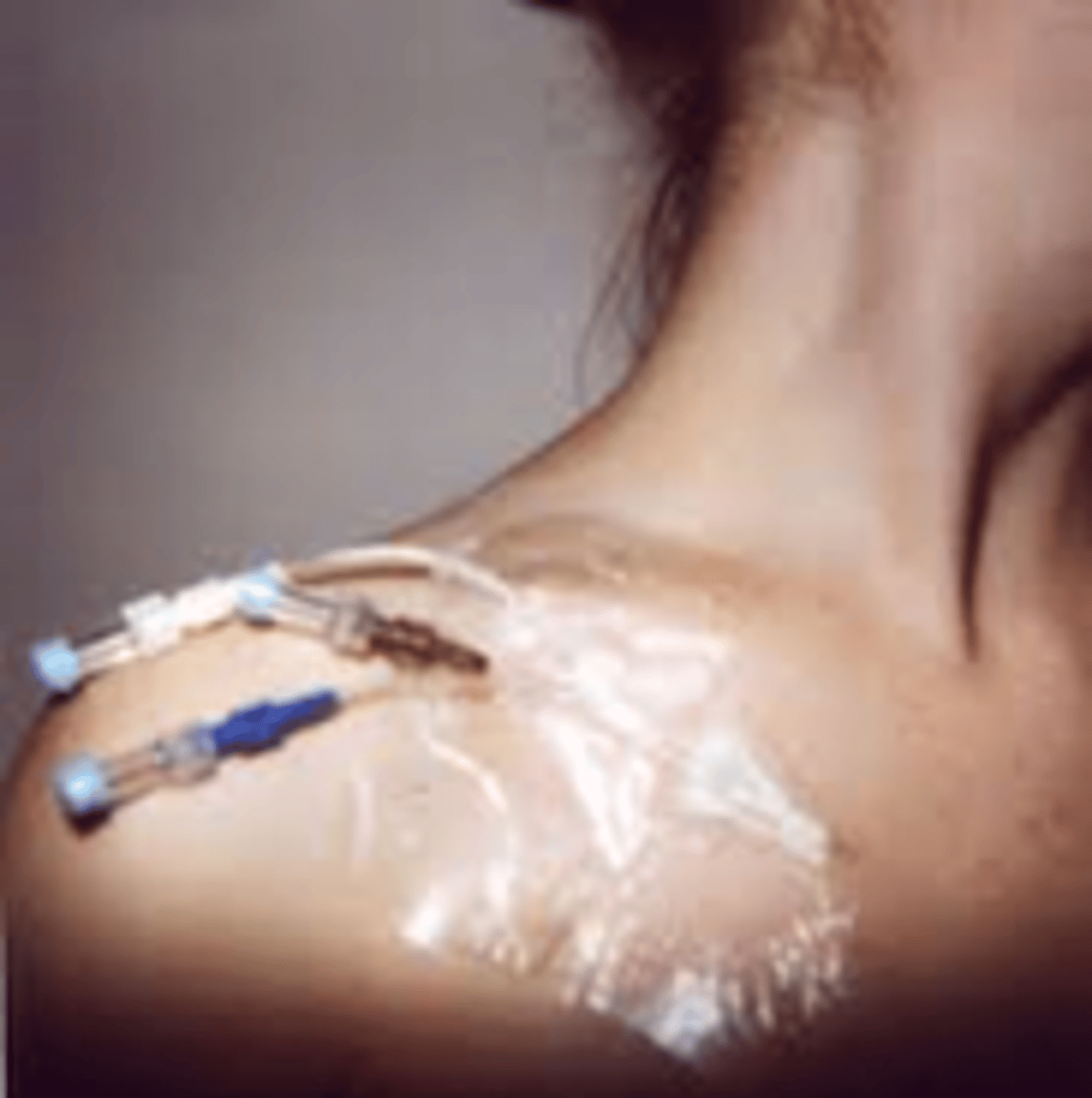 <p>catheter that directly monitors cardiac output</p>