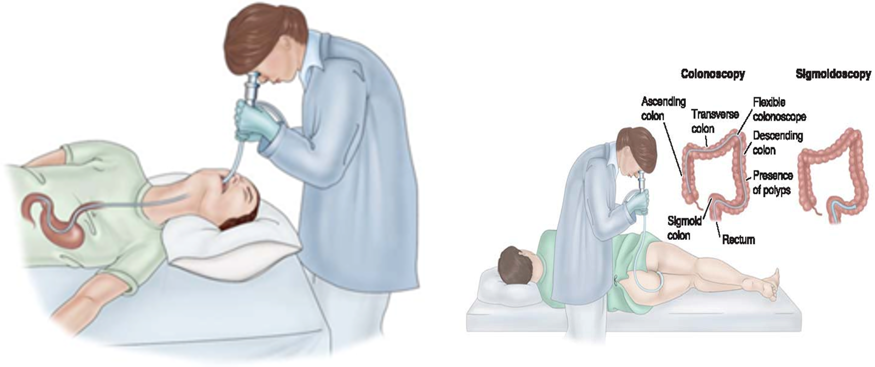 <ul><li><p>Direct visualization of esopahgeal, gastric (motility), and dudoneal mucosa </p><ul><li><p>Collect secretions and tissue specimens </p></li></ul></li><li><p>Topical anesthetics and moderate sedation </p></li><li><p>Diagnostic and/or therapeutic </p></li><li><p>Pt may get atropine to reduce secretions and/or glucagon to relax smooth muscle </p></li><li><p>Pt usually wares mouth gaurd to prevent biting the endoscope </p></li><li><p>Nursing care: </p><ul><li><p>NPO 8 hours before procedures </p></li><li><p>Priority during procedures: airway + oxygenation </p></li><li><p>Assess for signs of perforation </p></li><li><p>Relieve minor throat discomfort </p></li><li><p>Post-procedure education </p></li></ul></li><li><p><strong>Therapeutic endoscopy </strong></p><ul><li><p>Remove common bile duct stones </p></li><li><p>Dilate strictures </p></li><li><p>Treat gastric bleeding and esophageal varices </p></li></ul></li></ul><p></p>