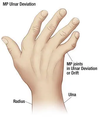 <p>Damage to the collateral ligaments and extensor mechanism at MCP which results in the pulling of fingers into UD, pronation and palmar subluxation. Classic occurrence with RA.</p>