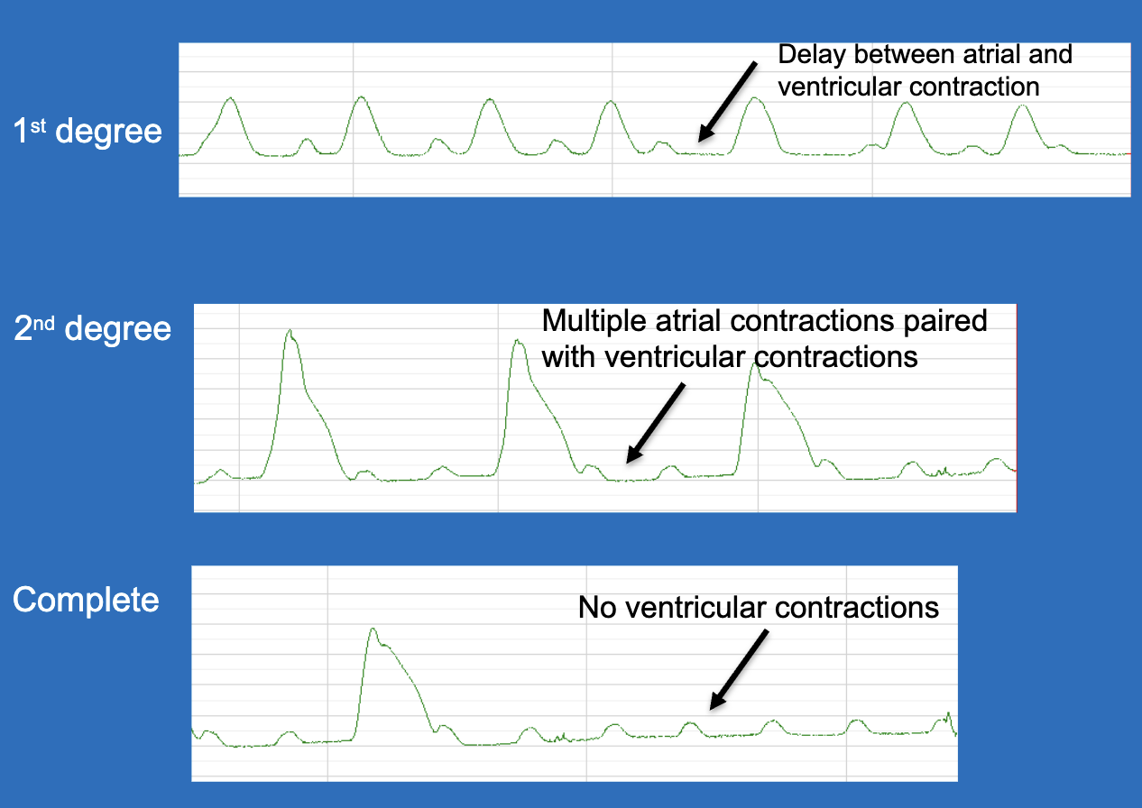 <ul><li><p>1st degree: delay between atrial and ventricular contractions</p></li><li><p>2nd degree: multiple atrial contractions paired with ventricular contractions</p></li><li><p>3rd/complete: no ventricular contractions</p></li></ul><p></p>