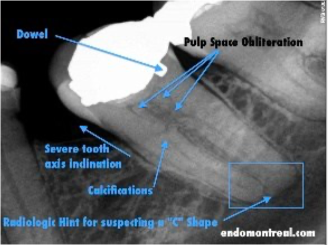 <p><span>calcify itself as a</span><span style="color: red;"><span> defense-mechanism</span></span></p><p><span>pulp canal has been calcified in response to injury</span></p>