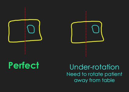 <ul><li><p>Pedicle is situated away from the vertebral body midline toward lateral border</p></li><li><p>More of the lamina is demoed (body of dog)</p></li></ul><p></p>
