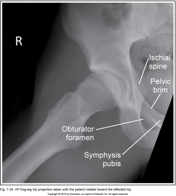 <p>AP frog leg hip (modified cleaves)</p>