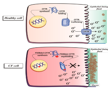 <ul><li><p>The cell of the lung normally produces a saline solution needed to allow our lungs to clear and remove mucus</p></li><li><p>This saline solution is made by a transporter protein in the plasma membrane called CFTR</p></li><li><p>In ppl w/ Cystic Fibrosis, the CFTR protein does not fold properly into its 3D shape, and this misfolding traps it in the endoplasmic reticulum, and blocks the production of saline</p></li><li><p>This causes mucus to becomes trapped and causes frequent and sometimes life-threatening lung infections</p></li></ul><p></p>