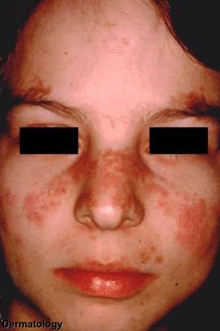 <p>malar area and nose</p>