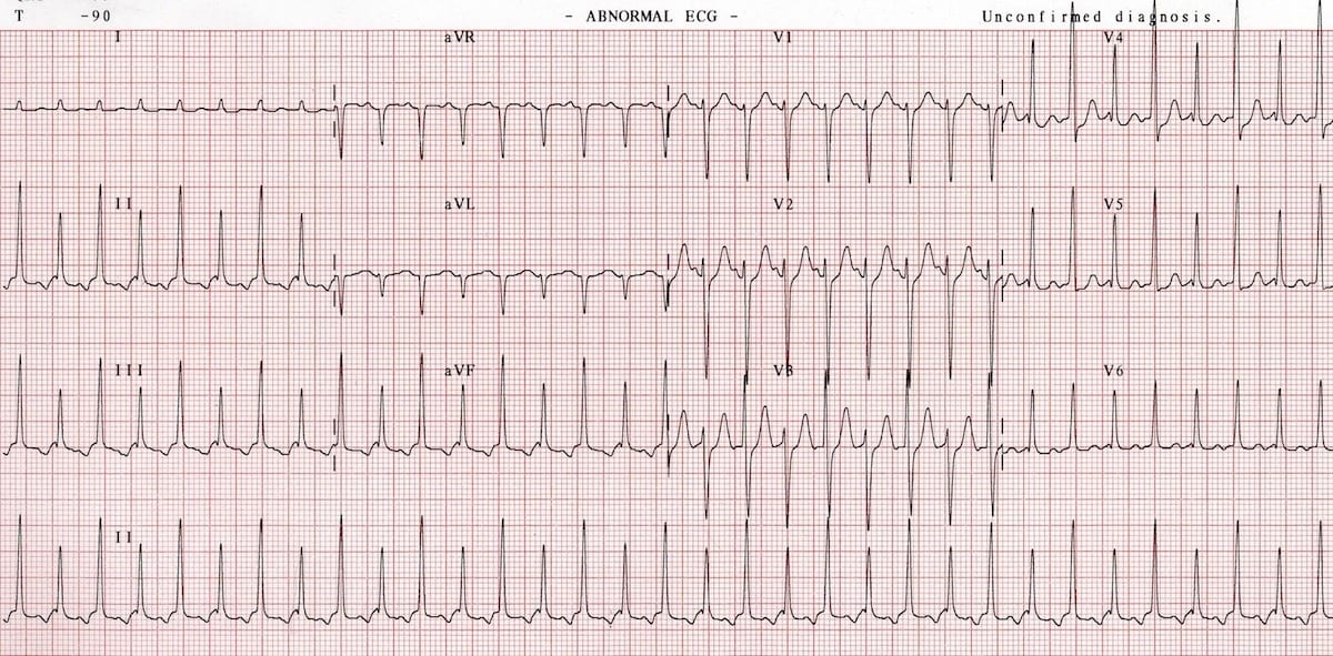 <p>What is the first line treatment for a patient with this EKG?A</p>