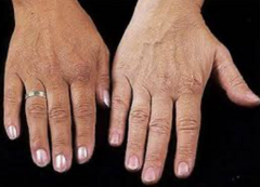 <p>skin bronzing, liver deposition on MRI, cardiomyopathy, hypogonadism, hypothyroidism, arthritis, HCC, diabetes</p>