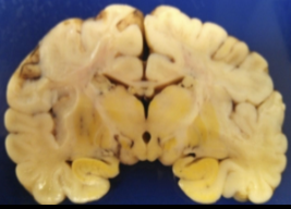 <p>Wanneer er teveel ongeconjugeerd bilirubine zich opstapelt in het lichaam (hyperbilirubinemie).</p><p>Ongeconjugeerd (niet omgezet door de lever) bilirubine kan makkelijk de bloed-hersenbarrière passeren, de stof is neurotoxisch. Als dit gebeurd ontstaat kernicterus, een gele verkleuring van de kernen van de basale ganglia, het hersenweefsel kan niet herstellen van deze schade. Het kan dodelijk zijn of zeer ernstige letsels veroorzaken. </p>