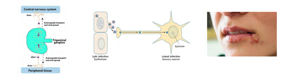 <p>- latent herpesvirus infections - HSV-1 and HSV-2 begin with lytic infection of an epithelium</p><p>- Virus replicates in the epithelium and latency is initiated when some of the offspring virions infect the sensory neurons that innervate the epithelium</p><p>- Virions that enter the terminally differentiated neurons traffic along the cytoskeleton to the cell nucleus , in the spinal column</p><p>- Herpesvirus genome circularises and persists as an episome in the nuclei of latently infected cells</p><p>- Multiple copies of episomal viral DNA remain in nucleus</p><p>.</p><p>- the virus persists because it is a DNA virus, meaning that it is proteced by capsid proteins and external structure of virus particle itself (virion prticle irself)</p>