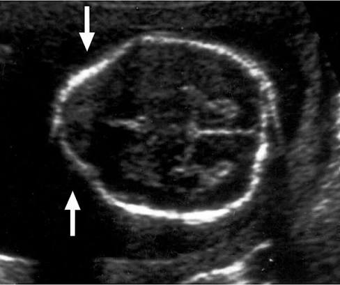 <ul><li><p>associated with spina bifida</p></li><li><p>bilateral indentation of frontal bones</p></li></ul><p></p>