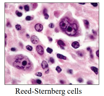 <p>Diagnosis on histology of lymph node or tissue:</p><p>- Reed-Sternberg cell: Large, bi- or multi-nucleate; prominent nucleoli ("owl eye"), Pathognomonic = indicative; characteristic of Hodgkin</p><p>- Inflammatory cells: lymphocytes, histiocytes, plasmacells, eosinophils</p><p>- Variable fibrosis</p><p>.</p><p>Sub-types based on histology:</p><p>- Classified by Pathologist</p><p>- Not of major clinical significance</p>