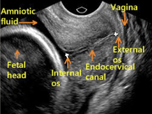 <ul><li><p>CL = distance between internal os and external cervical os</p></li><li><p>normal length (gravid uterus) is at least 3 cm</p></li><li><p>cervical incompetence is CL less than 2.5 cm</p><ul><li><p>short CL is marker for increased preterm birth loss</p></li><li><p>risk of loss inverselt proportional to CL</p></li></ul></li></ul><p></p>