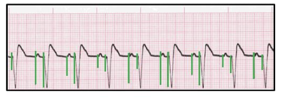<p>The identification of the above ECG is:</p><p>a. Pacemaker malfunction</p><p>b. Ventricular pacing</p><p>c. AV sequential pacing</p><p>d. Failure to sense</p>
