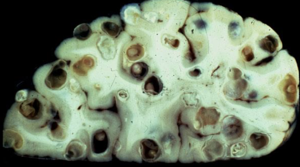 <p>What Helminth causes this?</p>