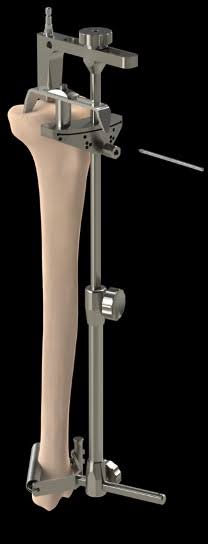<p>Guides the proximal tibial cut.</p>