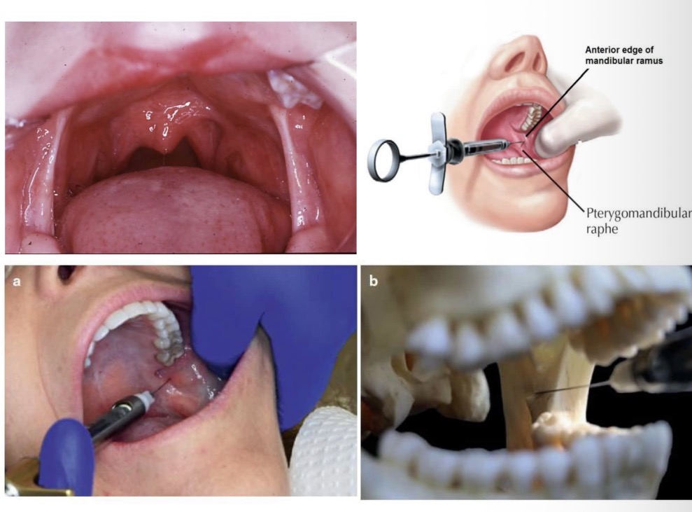 <p>Kodėl n. lingualis nuskausminamas kartu su n. alveolaris inferior?</p>