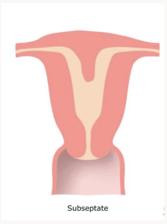 <p>The septum is only partially dividing the uterine cavity. Name the uterine anomaly </p>