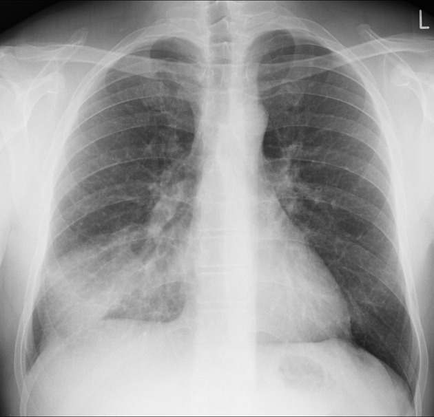 <p>What is the issue in this CXR?</p>