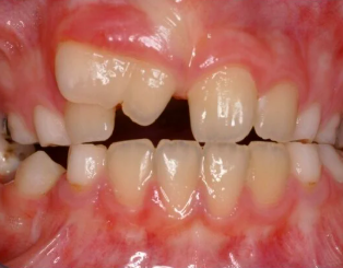 <p>1 crown, 2 roots</p><p>occurs when two developing teeth join together</p><ul><li><p><strong>characteristics:</strong></p><ul><li><p><span style="color: red;">produces an enlarged tooth</span></p></li><li><p>more <span style="color: red;">common in the primary</span> dentition</p></li><li><p>results in one fewer tooth in the affected area.</p></li></ul></li></ul><p></p>