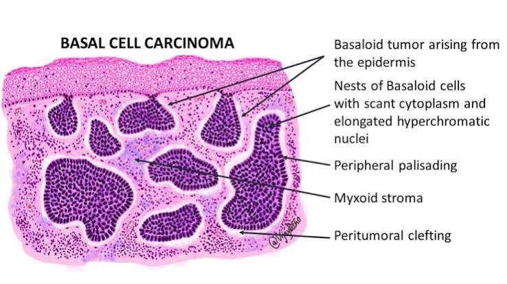 <p></p><p><span style="color: yellow;"><strong>BCC = 3 P's:</strong></span></p><ul><li><p><strong>P</strong>early papule<br><strong>P</strong>alisading cells<br><strong>P</strong>oor metastatic potential</p></li></ul><p></p>