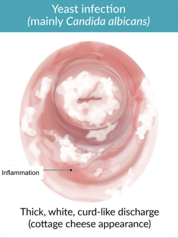 <p>Vaginal discharge</p><ul><li><p>White</p></li><li><p>Crumbly</p></li><li><p>Sticky</p></li></ul><p>Vulvovaginal erythema</p><p>Vaginal burning + pruritis</p><p>Dysuria</p><p>Dyspareunia</p>