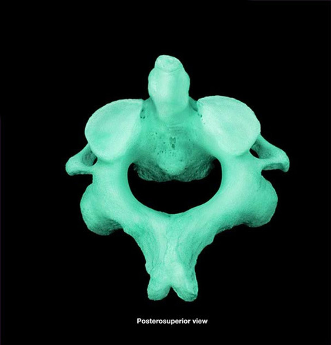 <p>the second cervical vertebrae (C2), allows the head to shake "no"</p>