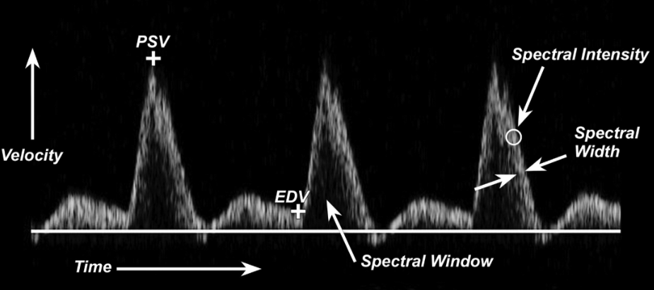 <ul><li><p>We can tell if flow <span style="background-color: transparent;">is turbulent or laminar based on the _____ _____</span></p><ul><li><p><span style="background-color: transparent;">The more open (black) the spectral window, the _____ turbulent the flow</span></p></li><li><p><span style="background-color: transparent;">The more filled in the spectral window, the _____ turbulent the flow</span></p></li></ul></li><li><p><span style="background-color: transparent;">We can tell how much blood we are sampling (how much blood is going through our pulse wave sample gate) based on how _____ the white part of the tracing is (spectral width)</span></p><ul><li><p><span style="background-color: transparent;">A thicker tracing = a _____ gate</span></p></li><li><p><span style="background-color: transparent;">A thinner tracing = a _____ gate</span></p></li></ul></li></ul><p></p>