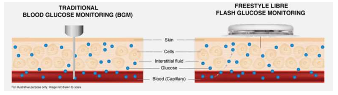 <ul><li><p>Sensor- has filament coated in glucose sensing enzymes- detects glucose in interstitial fluid</p></li><li><p>Sensor worn for number of days before being replaced and available for 24 hours a day</p></li></ul><ul><li><p>Implantable sensors can be used for longer- consist of a larger capsule compared to thin filaments in other CGMs</p></li><li><p>Sensor interacts with transmitter above skin to sends data to the receiver or smartphone app</p></li></ul><p></p>