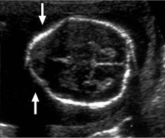 <p>frontal bone scalloping or indentation, presenting as flat or concave rather than the normal convex shape, most often found in the fetus with spina bifida</p>