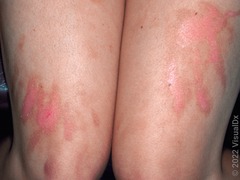 <p>+ Recent sun exposure at beach bar</p>