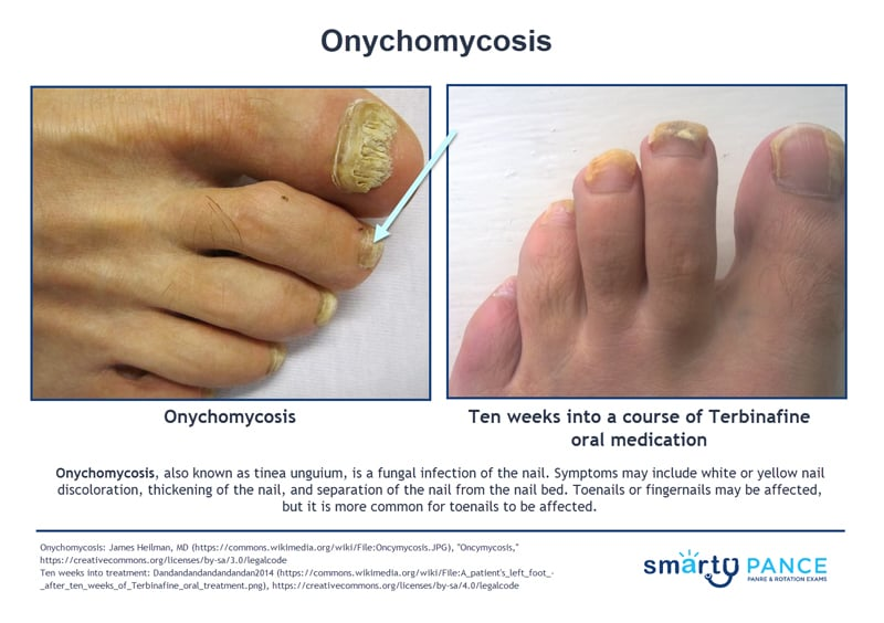 <p>Fungal infection of the nail</p><p>-Presentation: thick, discolored, brittle, crumbling nails with debris under it </p><p>-Dx: KOH prep of nail scrapings show branching hyphae </p><p>-Tx: oral terbinafine </p>