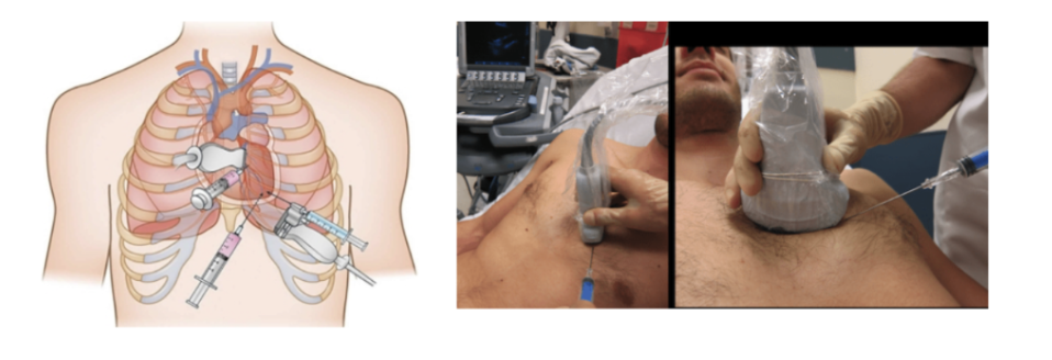 <ul><li><p><strong>Pericardiocentesis</strong>: An ultrasound-guided needle insertion used to remove fluid/blood from the pericardial sac to relieve pressure </p></li><li><p><strong>Resuscitative Thoracotomy</strong>: Opening the chest wall to gain access to the heart to control bleeding and relieve temponade </p></li></ul><p></p>