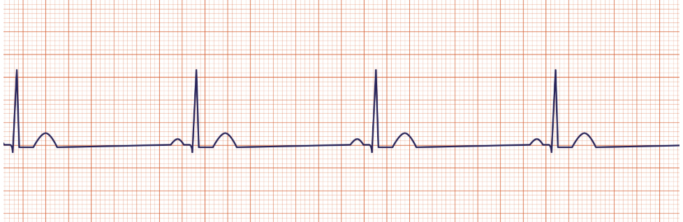 <p>Identify this rhythm?</p>