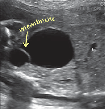 <ul><li><p>best visualized when the bladder is somewhat full</p></li><li><p>anechoic cystic surrounding by a thin echogenic membrane within the bladder</p></li><li><p>if bladder empty, ureterocele may be mistaken for small bladder</p></li><li><p>if bladder too full, ureterocele may be compressed</p></li><li><p>bladder should be evaluated multiple times through examination</p></li><li><p>possible renal duplication </p></li></ul><p></p>