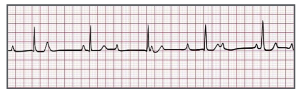 <p>Identify the above waveform:</p><p>a. First degree heart block</p><p>b. Third degree heart block</p><p>c. Second degree heart block type II</p><p>d. Second degree heart block type I</p>