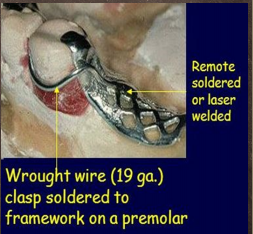 <p>What type of circumferential clasp/suprabuldge is shown</p>