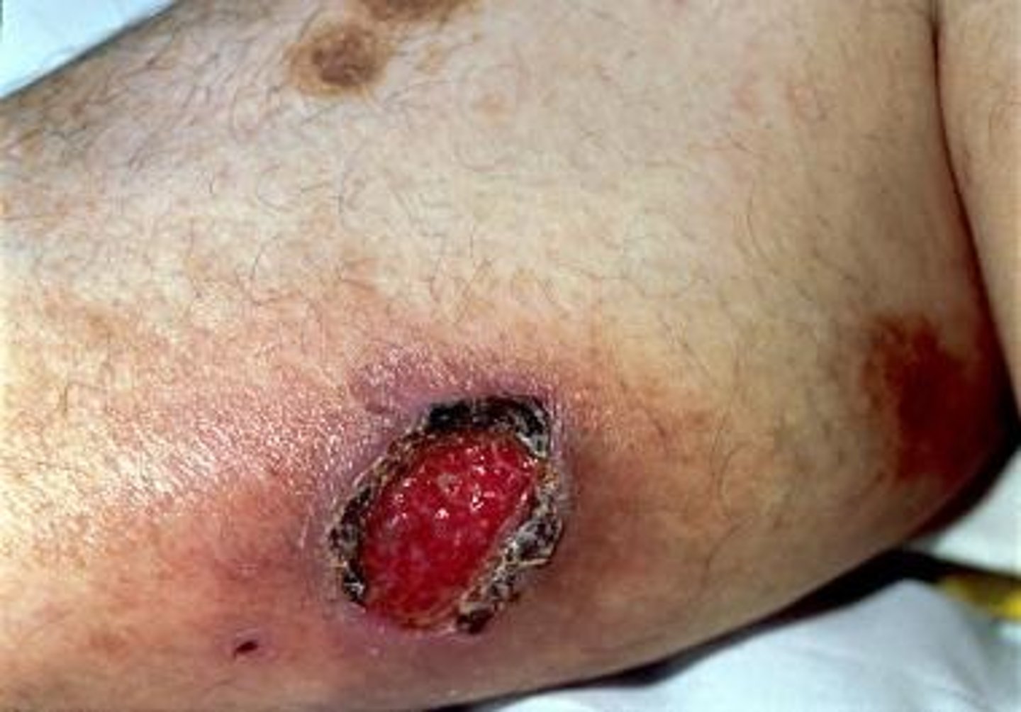 <p>- Mild to disseminated</p><p>- Rarely infectious (opportunistic)</p><p>- Fulminant (dense fungal burden) = fever, adenopathy, anemia</p><p>- Chronic respiratory infection</p><p>- Gilchrist's disease</p>
