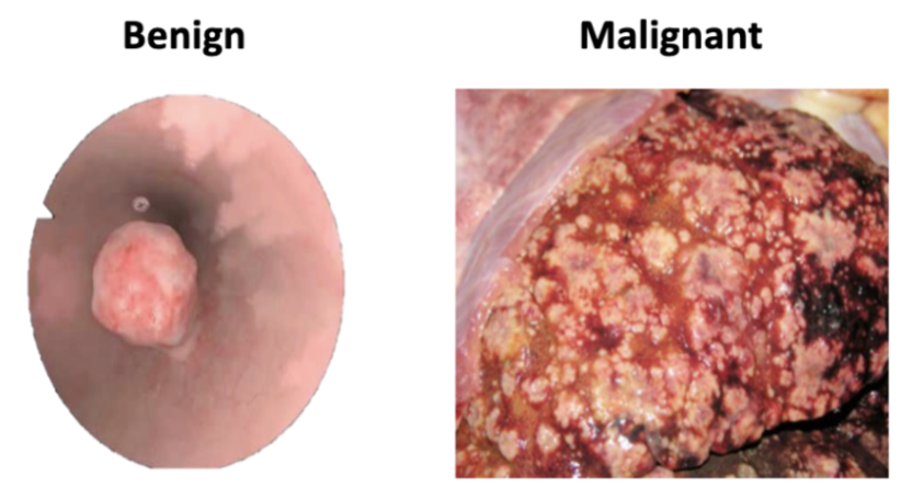 <ol><li><p><strong>Scirrhous response</strong> → reactive fibrous stroma → tumor feels <strong>firm</strong></p></li><li><p><strong>Necrosis</strong> → can cause <strong>ulceration and/or umbilication</strong></p></li></ol><p></p>