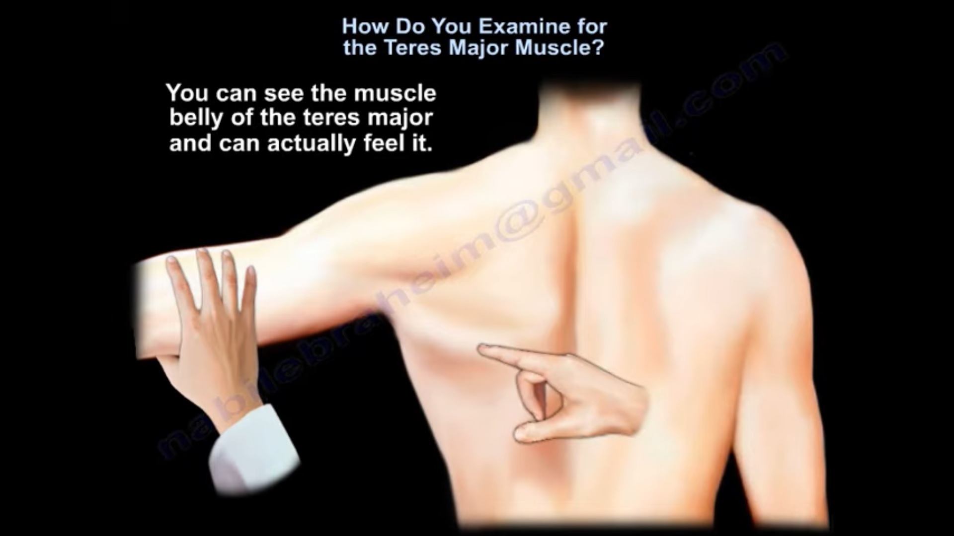 <p><strong>Location</strong>: Lateral scapular border, superior to teres major.</p><p></p><p>Confirm: External rotation at 45° abduction activates it.</p>