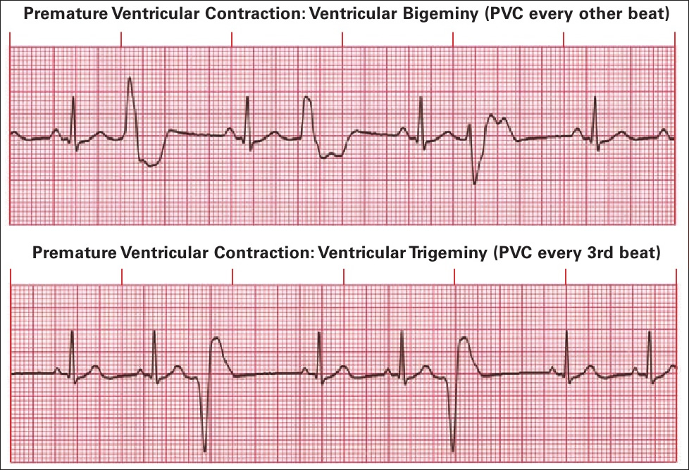 <p><strong>Premature </strong>Ventricular Contractions</p><ol><li><p>has a <strong>wide, </strong><span style="color: rgb(189, 23, 209);"><strong>abnormal QRS </strong></span><strong>complex</strong></p></li><li><p>person may feel <strong>skipped </strong>beat</p></li></ol><p></p>