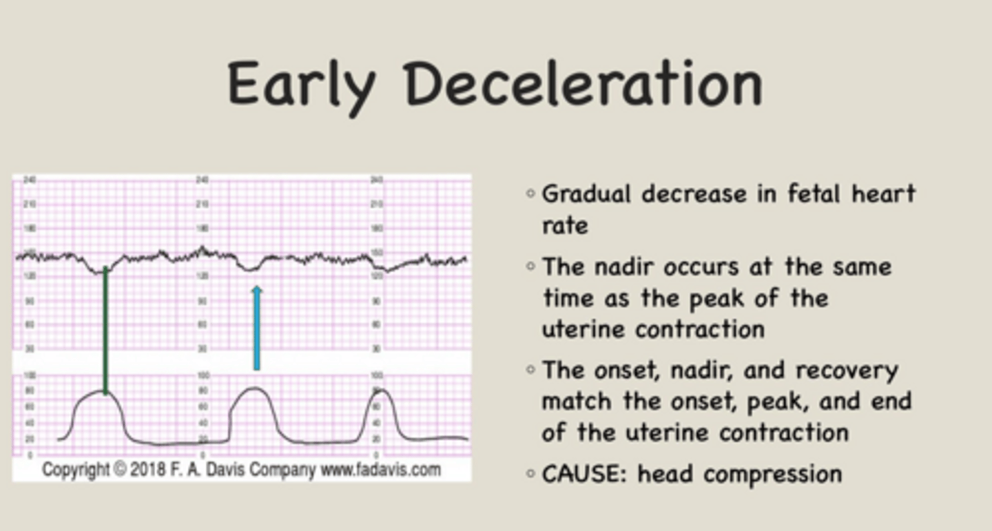 <p>Fetal head compression, usually benign.</p>