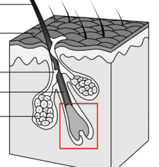 <p>swollen base SITS ON PAPILLA</p>
