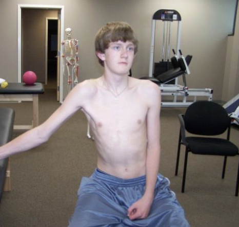 <p>Each subject was placed in an upright sitting position with the test arm abducted to 90° with fist clenched on a firm supportive surface. Each subject was instructed to apply pressure with his or her fist in the direction of arm adduction and instructed to inferiorly depress their scapula and hold this position for 5 seconds</p><p>Note: Isometric nd closed chaine. Good for SA contraction with less lower trap. Adduction force causes increased SA Space</p>