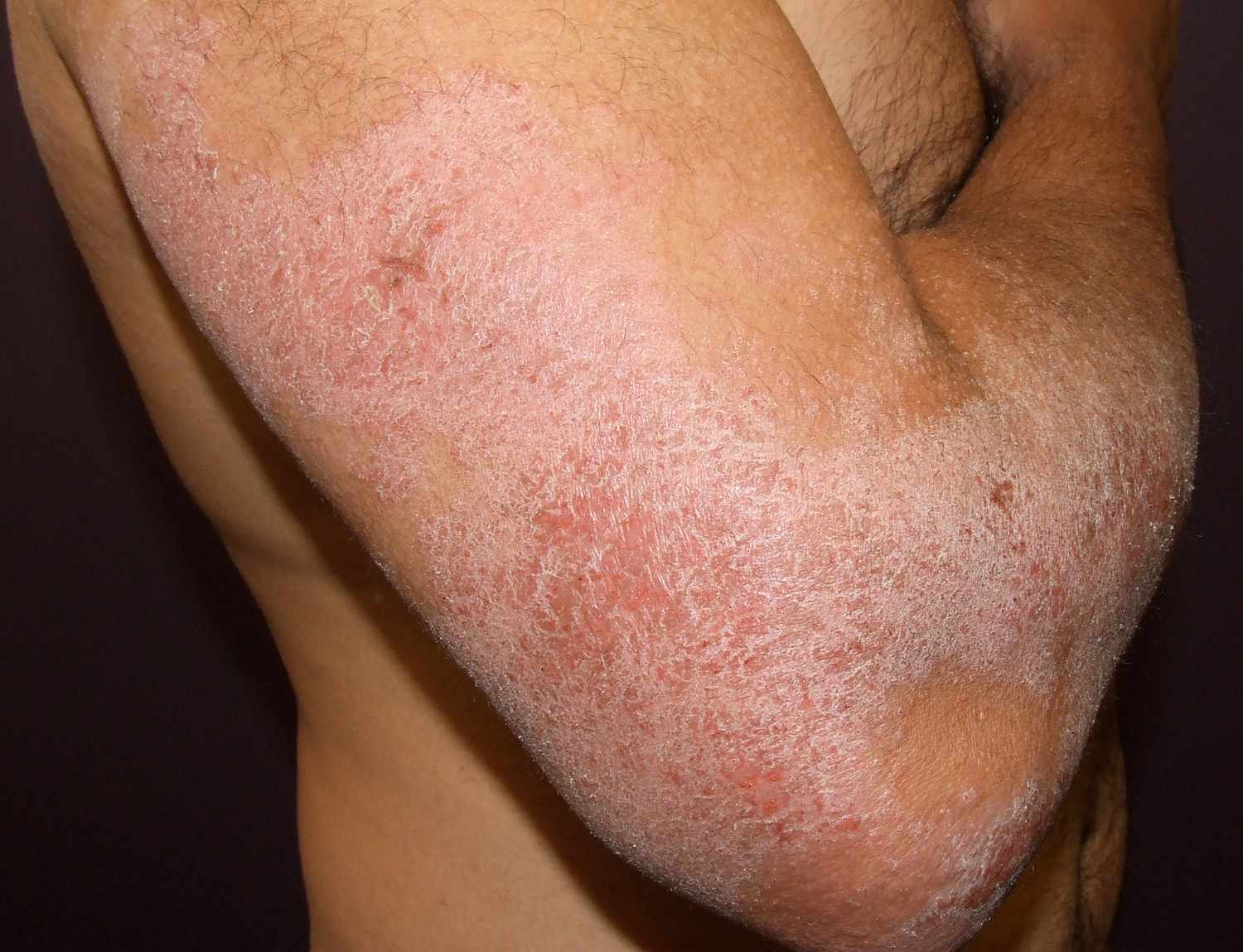 <p>erythematous plaques that are chronic, excoriated, lichenified with intense pruritis. no correlation to drugs. = ?</p>
