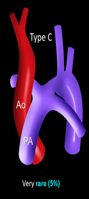 <p>when interruption occurs proximal to the LCCA between the brachiocephaic art</p>