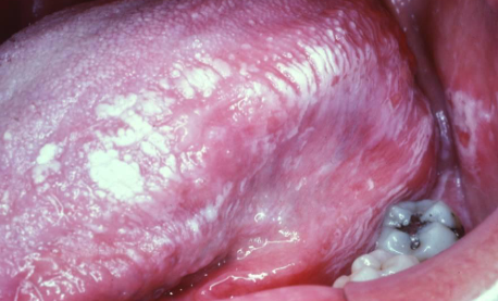 <p>topical allergic reaction; generalized or localized; may burn or be painful; goes away if product causing irritation is not used/ removed </p>